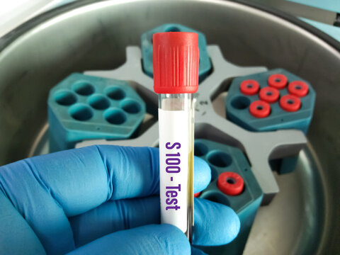 Blood Sample For S-100 B(S100 Calcium-binding Protein B) Test, For Disease Monitoring In Metastatic Melanoma. Dermatology.