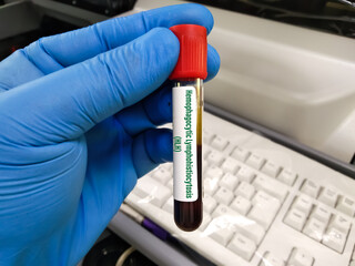 Blood sample for HLH or Hemophagocytic Lymphohistiocytosis, a rare fatal condition in which white...