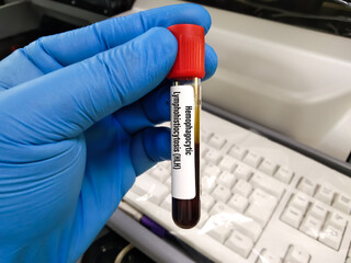 Blood sample for HLH or Hemophagocytic Lymphohistiocytosis, a rare fatal condition in which white...