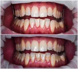teeth deep cleaning and polishing