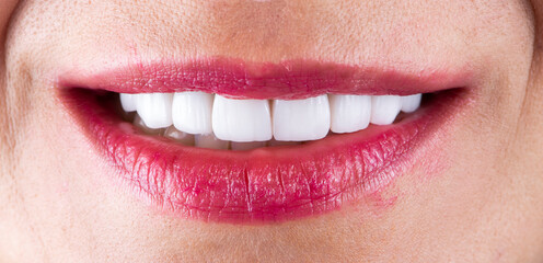 Fototapeta premium creating a new smile by ceramic crowns and veneers