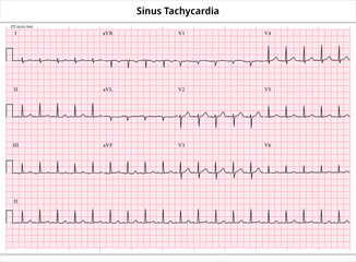 ECG Sinus Tachycardia - 12 Leads ECG Paper - Vector - Medical Illustration