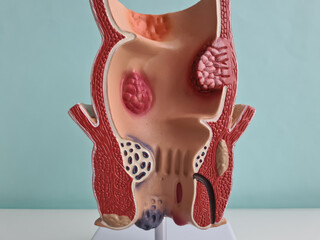 Anatomical model of rectum with hemorrhoids closeup