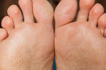 Damaged skin on the feet