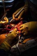 Chirurgie pelvectomie urologie