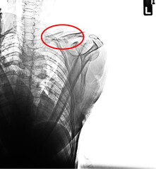 Fracture left clavicle x-ray trans in the red circle