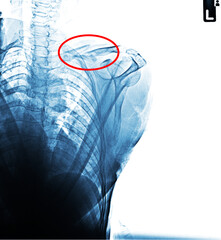 Fototapeta na wymiar Fracture left clavicle x-ray trans in the red circle