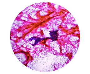 Metastatic adenocarcinoma. Papillary adenocarcinoma, a type of non small cell carcinoma.
