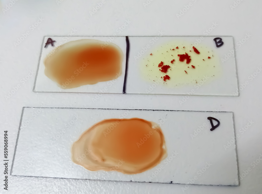 Poster B Negative rare blood group. ABO Blood Grouping.