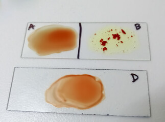 B Negative rare blood group. ABO Blood Grouping.