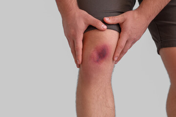 Man with bruise on knee against light background, closeup