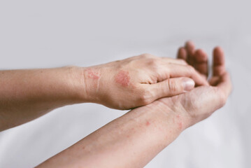Itching on hands with redness rash. Cause of itchy skin include dermatitis (eczema), dry skin, burned, food,drug allergies, insect bites. Health care concept.
