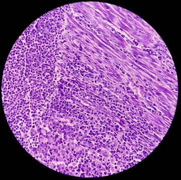 Uterus wall consist pyometra with cervicitis, photomicrograph show dense infiltration of polymorphs, lymphocytes, histiocytes and necrotic material.