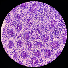 Transverse colon microscopic image seen atypical cell, colonic mucosa, infiltration of inflammatory cells.