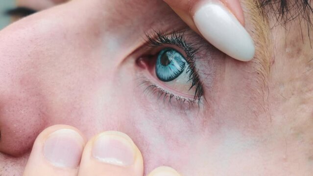 A contact lens with a blue pupil in the eye. The man turns his eye in different directions to adapt to the contact lens