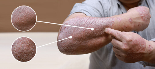 Macro detailed circles magnification psoriasis skin. Male showing arm with blue red cracked, hard,...