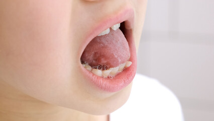 Child shows his loose milk tooth presses and pushes it with his tongue. Open mouth close-up....