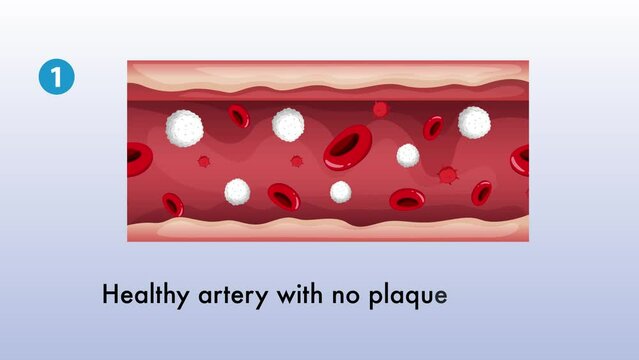 Arteriosclerotic vascular disease (Atherosclerosis) animation