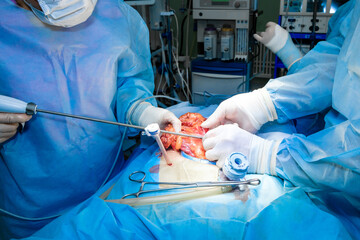 A team of surgeons in sterile gloves and a surgical uniform uses laparoscopic surgical instruments during surgery. Selective focus.