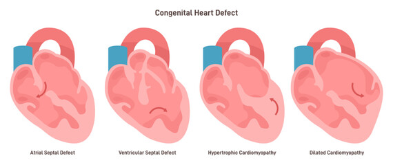 Congenital diseases of the heart set. Ventricular and atrial septal defect, - obrazy, fototapety, plakaty