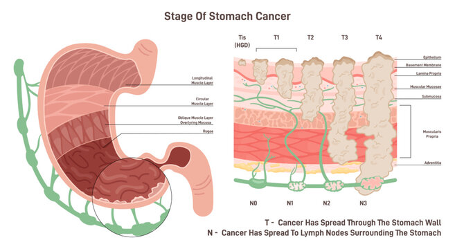 Stages of stomach cancer. Growth of pathological malignant cells