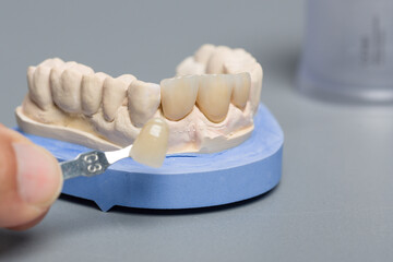 Dental imprint with artificial dentition and shade guide to check veneer of teeth in a dental...