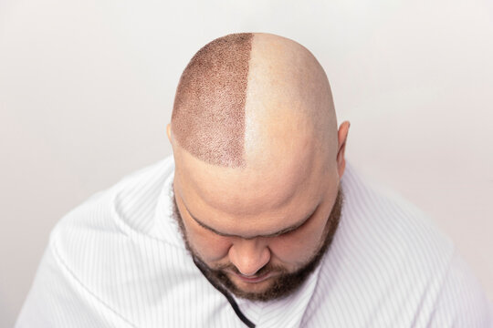 male baldness before and after treatment. portrait of man with baldness problem at a hair transplant operation. Cosmetic surgery. the process of hair transplantation on the head.