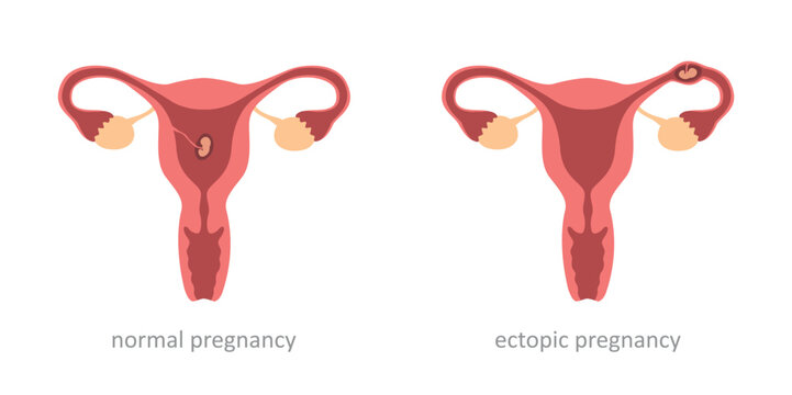 womens health normal and ectopic pregnancy embryo