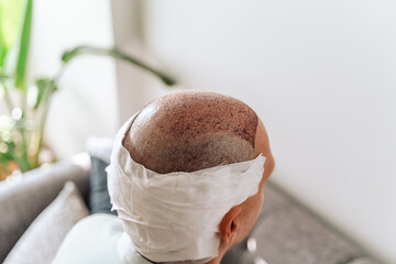 After hair transplantation surgical technique that moves hair follicles. Young bald man in bandage...