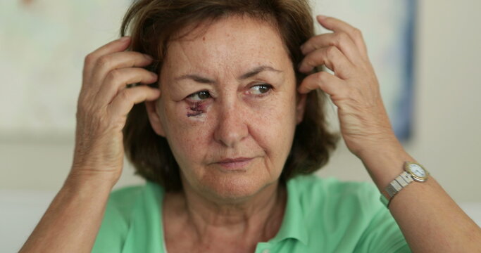 Older woman with bruised face adjusting hair