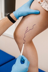 The phlebologist is marking legs before surgery to remove the veins. The vascular surgeon is...