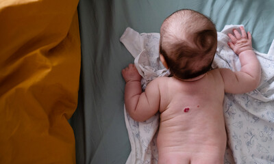 hemangioma on the back of a baby. view from above. a red spot. skin diseases of newborn