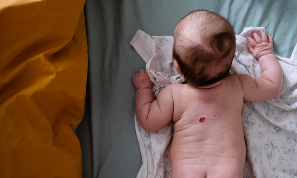 hemangioma on the back of a baby. view from above. a red spot. skin diseases of newborn