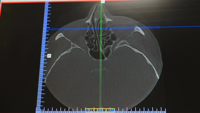 Computed tomography of human Paranasal Sinuses. Monitor shot. MRI CT scan of Orbit, Diagnostic medical equipment in modern dentistry. healthcare, medical procedure. 4 k video