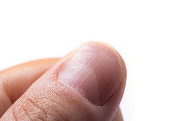 Ridged fingernail of a thumb finger of a man with vertical ridges on white background
