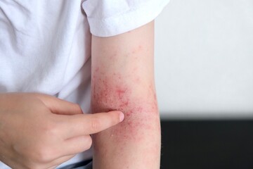The child scratches atopic skin. Dermatitis, diathesis, allergy on the child's body.	 - obrazy, fototapety, plakaty