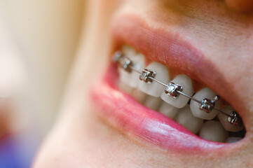 Dental braces in happy womans mouths on brackets on the teeth after whitening. Self-ligating...