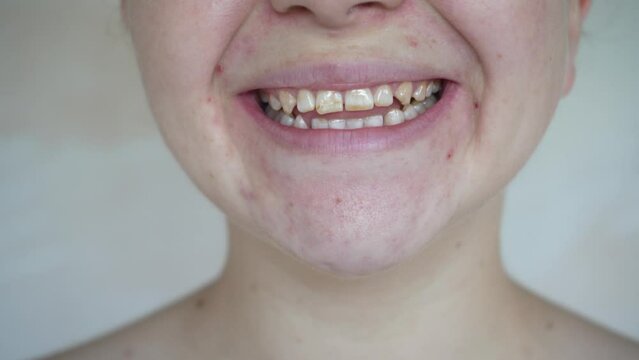 A young girl smiles and shows crooked teeth. The concept of dental problems.