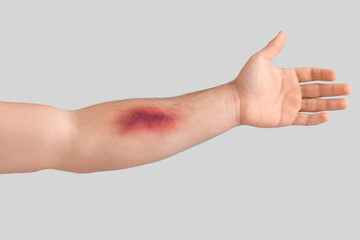Male arm with bruise on light background