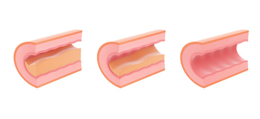 Anatomical 3d illustration clogged and healthy capillary vessel. Three phases of the disease.