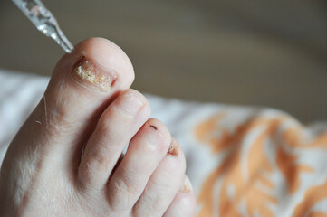 toenail fungus. human viral diseases. background for the design.