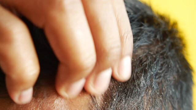 men with dandruff in his hair, closeup 