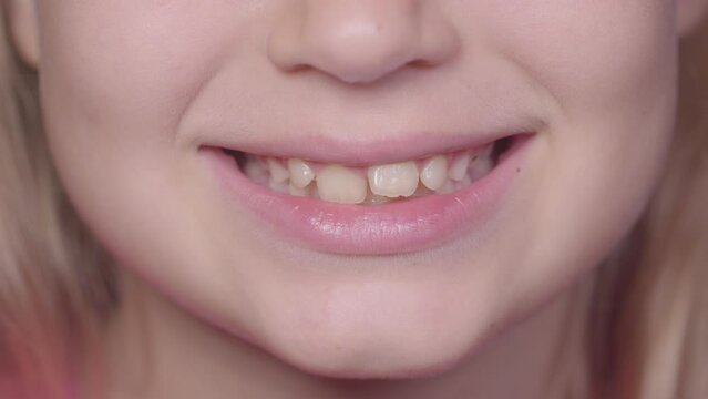 A teenage girl demonstrates her crooked teeth.