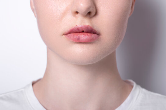 real women's bruised lips after lip augmentation injection of hyaluronic acid close-up, complications and hematomas after a beauty hyaluronan injection on female lips, contour lip plastic surgery