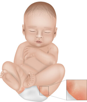 Diaper Rash or Irritant Diaper Dermatitis. Inflammation of the skin under a diaper. Jacquet Dermatitis. Infant with diaper rash in groin area.