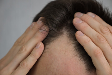 Fototapeta premium Young man touches hair with hands worrying about baldness. Concerned male person fights with alopecia standing against grey wall in room closeup