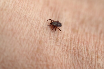 mite,Ixodid, encephalitic live tick on the human body close-up, macro photography.