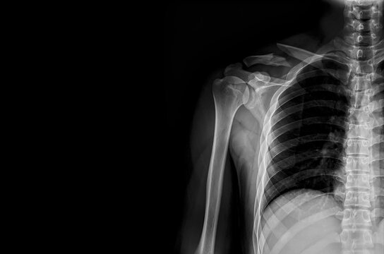 Plain radiograph of human shoulder after accident.The film shown calcific tendinitis of rotator cuff.Patient came to hospital with severe pain. Medical concept.