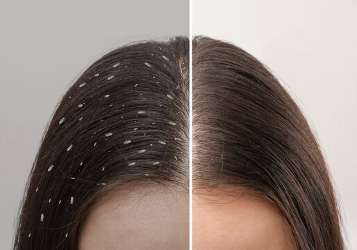Collage showing woman's hair before and after lice treatment on light background, closeup. Suffering from pediculosis