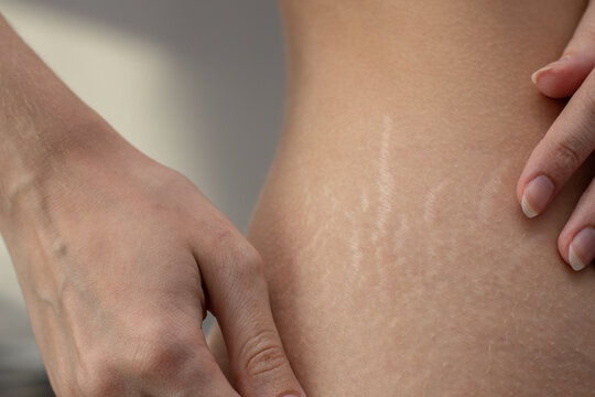 Woman Hips With Visible Stretch Marks. Young Woman Showing Stretch Mark Scars On Her Body